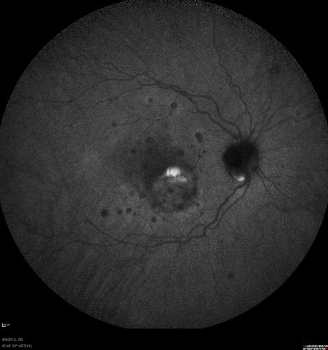 Punctate Inner Choroidopathy - PIC and Choroidal Neovascular Membrane - Right Eye - ICG Angiogram
34-year-old woman with a change in vision in the right eye about eight days ago.  Her vision was hazy and she saw waviness in the vision.  She does have a history of aches and pains and she was diagnosed with Sjogrenâ€™s and 2 months ago she had some fevers and some sinus drainage and that went on for about two months.  She is a moderate myope.    OD 20/25, OS 20/20.   
