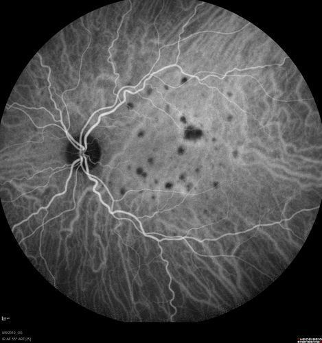 Punctate Inner Choroidopathy - PIC and Choroidal Neovascular Membrane - Right Eye - ICG Angiogram
34-year-old woman with a change in vision in the right eye about eight days ago.  Her vision was hazy and she saw waviness in the vision.  She does have a history of aches and pains and she was diagnosed with Sjogrenâ€™s and 2 months ago she had some fevers and some sinus drainage and that went on for about two months.  She is a moderate myope.    OD 20/25, OS 20/20.   
