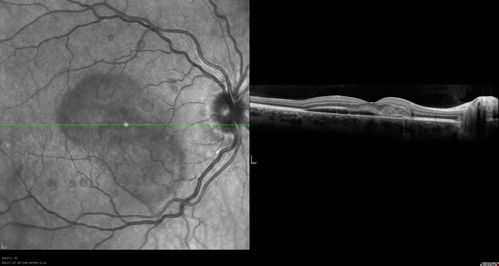 Punctate Inner Choroidopathy - PIC and Choroidal Neovascular Membrane - Right Eye - SD OCT
34-year-old woman with a change in vision in the right eye about eight days ago.  Her vision was hazy and she saw waviness in the vision.  She does have a history of aches and pains and she was diagnosed with Sjogrenâ€™s and 2 months ago she had some fevers and some sinus drainage and that went on for about two months.  She is a moderate myope.    OD 20/25, OS 20/20.   
