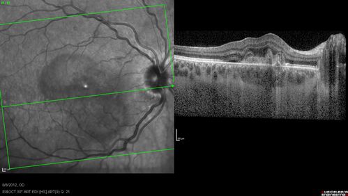 Punctate Inner Choroidopathy - PIC and Choroidal Neovascular Membrane - Right Eye - SD OCT
34-year-old woman with a change in vision in the right eye about eight days ago.  Her vision was hazy and she saw waviness in the vision.  She does have a history of aches and pains and she was diagnosed with Sjogrenâ€™s and 2 months ago she had some fevers and some sinus drainage and that went on for about two months.  She is a moderate myope.    OD 20/25, OS 20/20.   
