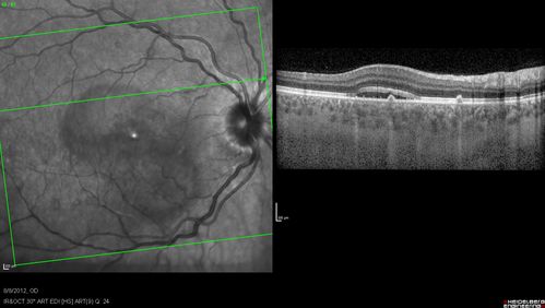 Punctate Inner Choroidopathy - PIC and Choroidal Neovascular Membrane - Right Eye - SD OCT
34-year-old woman with a change in vision in the right eye about eight days ago.  Her vision was hazy and she saw waviness in the vision.  She does have a history of aches and pains and she was diagnosed with Sjogrenâ€™s and 2 months ago she had some fevers and some sinus drainage and that went on for about two months.  She is a moderate myope.    OD 20/25, OS 20/20.   
