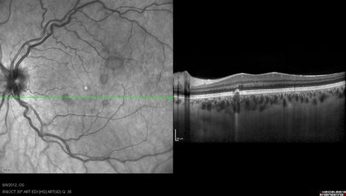 Punctate Inner Choroidopathy - PIC and Choroidal Neovascular Membrane - Right Eye - SD OCT
34-year-old woman with a change in vision in the right eye about eight days ago.  Her vision was hazy and she saw waviness in the vision.  She does have a history of aches and pains and she was diagnosed with Sjogrenâ€™s and 2 months ago she had some fevers and some sinus drainage and that went on for about two months.  She is a moderate myope.    OD 20/25, OS 20/20.   
