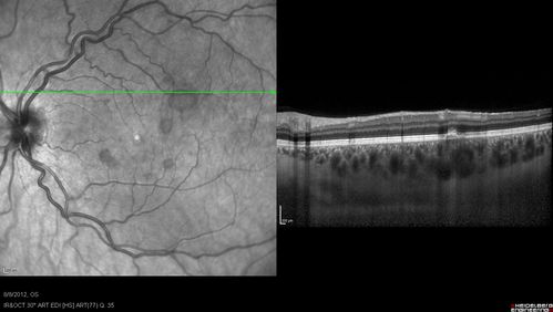 Punctate Inner Choroidopathy - PIC and Choroidal Neovascular Membrane - Right Eye - SD OCT
34-year-old woman with a change in vision in the right eye about eight days ago.  Her vision was hazy and she saw waviness in the vision.  She does have a history of aches and pains and she was diagnosed with Sjogrenâ€™s and 2 months ago she had some fevers and some sinus drainage and that went on for about two months.  She is a moderate myope.    OD 20/25, OS 20/20.   
