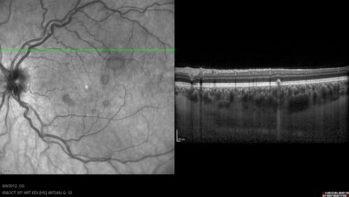 Punctate Inner Choroidopathy - PIC and Choroidal Neovascular Membrane - Right Eye - SD OCT
34-year-old woman with a change in vision in the right eye about eight days ago.  Her vision was hazy and she saw waviness in the vision.  She does have a history of aches and pains and she was diagnosed with Sjogrenâ€™s and 2 months ago she had some fevers and some sinus drainage and that went on for about two months.  She is a moderate myope.    OD 20/25, OS 20/20.   
