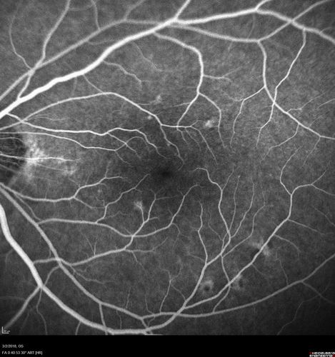 Punctate Inner Choroidopathy - New CNVM right eye
42 year old female with recent vision loss in the right eye - Right eye is 20/80 - Vision improved to 20/16 with Ranabizumab injections over 3 months
