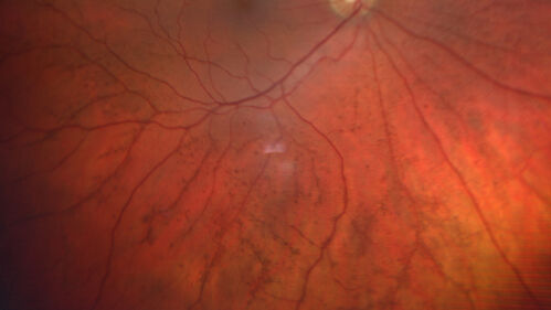 Posterior Pigment Dispersion Syndrome
81 year old man with cataract surgery 30 years ago and normal vision who had bilateral vitrectomy for dense floaters and has pigment on his IOL surface and all over the retina (but not on the cornea) VA 20/25 OU
