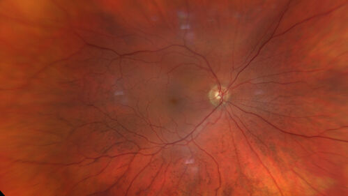 Posterior Pigment Dispersion Syndrome
81 year old man with cataract surgery 30 years ago and normal vision who had bilateral vitrectomy for dense floaters and has pigment on his IOL surface and all over the retina (but not on the cornea) VA 20/25 OU
