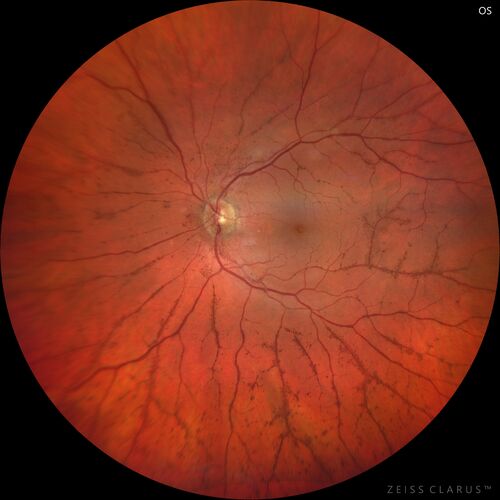 Posterior Pigment Dispersion Syndrome
81 year old man with cataract surgery 30 years ago and normal vision who had bilateral vitrectomy for dense floaters and has pigment on his IOL surface and all over the retina (but not on the cornea) VA 20/25 OU
