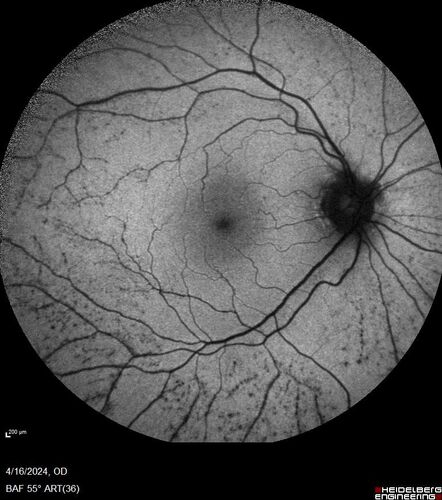Posterior Pigment Dispersion Syndrome
81 year old man with cataract surgery 30 years ago and normal vision who had bilateral vitrectomy for dense floaters and has pigment on his IOL surface and all over the retina (but not on the cornea) VA 20/25 OU
