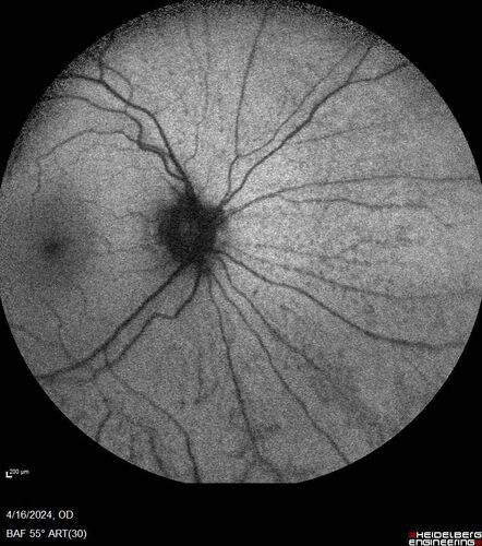 Posterior Pigment Dispersion Syndrome
81 year old man with cataract surgery 30 years ago and normal vision who had bilateral vitrectomy for dense floaters and has pigment on his IOL surface and all over the retina (but not on the cornea) VA 20/25 OU
