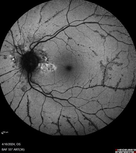 Posterior Pigment Dispersion Syndrome
81 year old man with cataract surgery 30 years ago and normal vision who had bilateral vitrectomy for dense floaters and has pigment on his IOL surface and all over the retina (but not on the cornea) VA 20/25 OU
