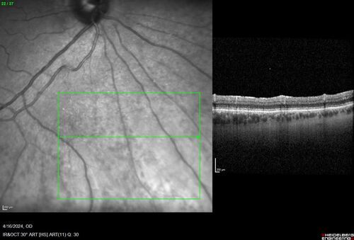 Posterior Pigment Dispersion Syndrome
81 year old man with cataract surgery 30 years ago and normal vision who had bilateral vitrectomy for dense floaters and has pigment on his IOL surface and all over the retina (but not on the cornea) VA 20/25 OU
