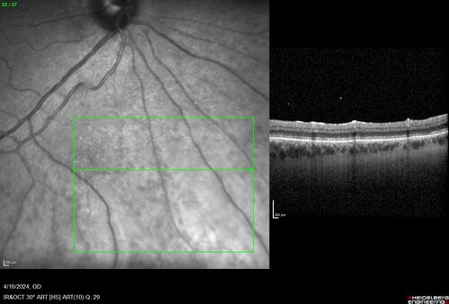 Posterior Pigment Dispersion Syndrome
81 year old man with cataract surgery 30 years ago and normal vision who had bilateral vitrectomy for dense floaters and has pigment on his IOL surface and all over the retina (but not on the cornea) VA 20/25 OU
