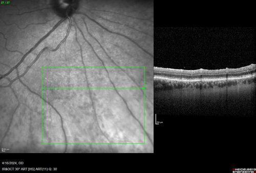 Posterior Pigment Dispersion Syndrome
81 year old man with cataract surgery 30 years ago and normal vision who had bilateral vitrectomy for dense floaters and has pigment on his IOL surface and all over the retina (but not on the cornea) VA 20/25 OU
