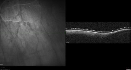 Posterior Pigment Dispersion Syndrome
81 year old man with cataract surgery 30 years ago and normal vision who had bilateral vitrectomy for dense floaters and has pigment on his IOL surface and all over the retina (but not on the cornea) VA 20/25 OU
