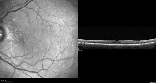 Posterior Pigment Dispersion Syndrome
81 year old man with cataract surgery 30 years ago and normal vision who had bilateral vitrectomy for dense floaters and has pigment on his IOL surface and all over the retina (but not on the cornea) VA 20/25 OU
