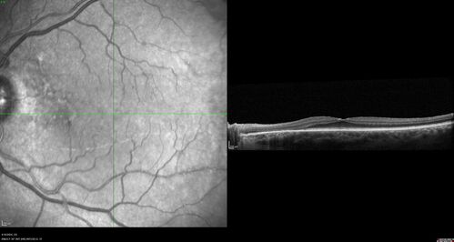 Posterior Pigment Dispersion Syndrome
81 year old man with cataract surgery 30 years ago and normal vision who had bilateral vitrectomy for dense floaters and has pigment on his IOL surface and all over the retina (but not on the cornea) VA 20/25 OU

