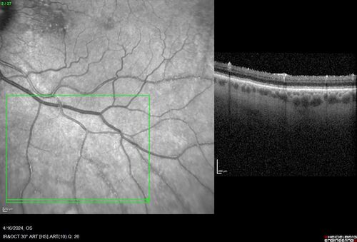 Posterior Pigment Dispersion Syndrome
81 year old man with cataract surgery 30 years ago and normal vision who had bilateral vitrectomy for dense floaters and has pigment on his IOL surface and all over the retina (but not on the cornea) VA 20/25 OU
