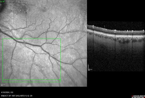Posterior Pigment Dispersion Syndrome
81 year old man with cataract surgery 30 years ago and normal vision who had bilateral vitrectomy for dense floaters and has pigment on his IOL surface and all over the retina (but not on the cornea) VA 20/25 OU
