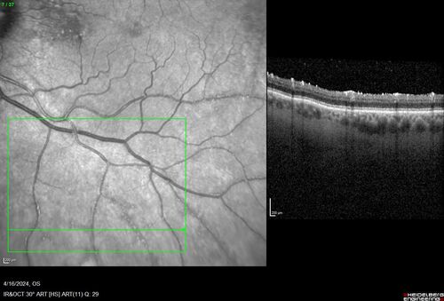 Posterior Pigment Dispersion Syndrome
81 year old man with cataract surgery 30 years ago and normal vision who had bilateral vitrectomy for dense floaters and has pigment on his IOL surface and all over the retina (but not on the cornea) VA 20/25 OU
