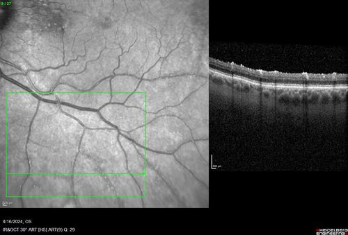 Posterior Pigment Dispersion Syndrome
81 year old man with cataract surgery 30 years ago and normal vision who had bilateral vitrectomy for dense floaters and has pigment on his IOL surface and all over the retina (but not on the cornea) VA 20/25 OU

