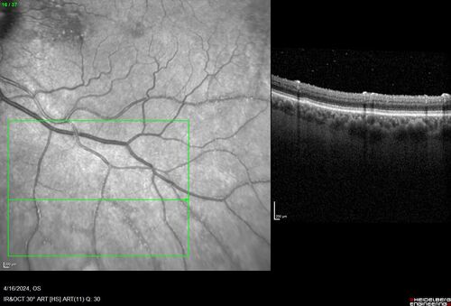 Posterior Pigment Dispersion Syndrome
81 year old man with cataract surgery 30 years ago and normal vision who had bilateral vitrectomy for dense floaters and has pigment on his IOL surface and all over the retina (but not on the cornea) VA 20/25 OU
