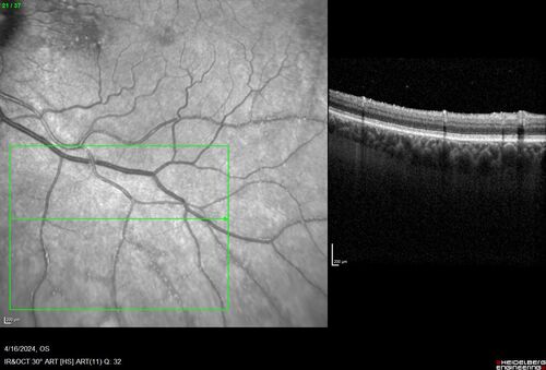 Posterior Pigment Dispersion Syndrome
81 year old man with cataract surgery 30 years ago and normal vision who had bilateral vitrectomy for dense floaters and has pigment on his IOL surface and all over the retina (but not on the cornea) VA 20/25 OU

