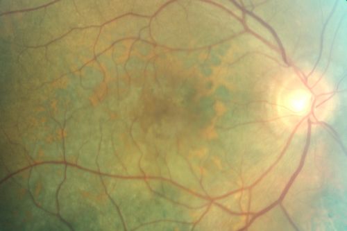 Pigmented Choroidal Mass Right Eye - Melanoma vs. Nevus vs. Unilateral Melanocytic Proliferation - 4 Month Follow-Up Images
71-year-old man his vision 4 month follow-up.  Vision is 20/60 and patient sees flashing lights.  Lesion has grown slightly in the superior half of the macula.
