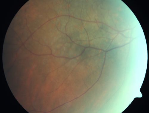 Pigmented Choroidal Mass Right Eye - Melanoma vs. Nevus vs. Unilateral Melanocytic Proliferation - 4 Month Follow-Up Images
71-year-old man his vision 4 month follow-up.  Vision is 20/60 and patient sees flashing lights.  Lesion has grown slightly in the superior half of the macula.
