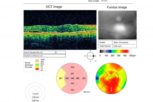 Pigmented Choroidal Mass Right Eye - Melanoma vs. Nevus vs. Unilateral Melanocytic Proliferation - 4 Month Follow-Up Images
71-year-old man his vision 4 month follow-up.  Vision is 20/60 and patient sees flashing lights.  Lesion has grown slightly in the superior half of the macula.

