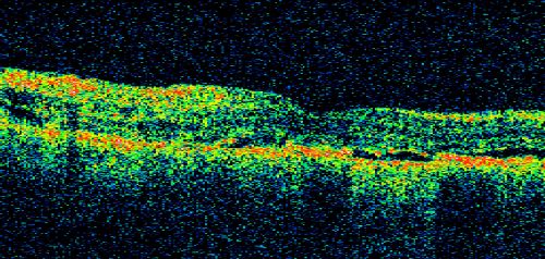 Pigmented Choroidal Mass Right Eye - Melanoma vs. Nevus vs. Unilateral Melanocytic Proliferation - 4 Month Follow-Up Images
71-year-old man his vision 4 month follow-up.  Vision is 20/60 and patient sees flashing lights.  Lesion has grown slightly in the superior half of the macula.
