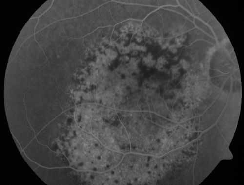 Pigmented Choroidal Mass Right Eye - Melanoma vs. Nevus vs. Unilateral Melanocytic Proliferation - 4 Month Follow-Up Images
71-year-old man his vision 4 month follow-up.  Vision is 20/60 and patient sees flashing lights.  Lesion has grown slightly in the superior half of the macula.
