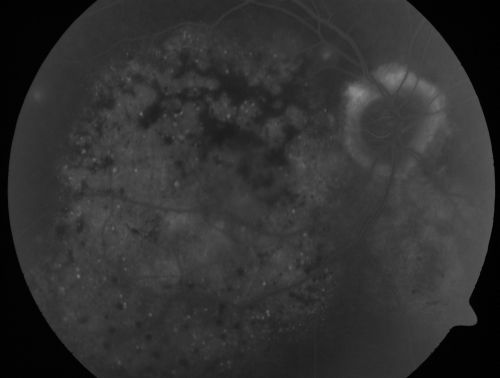 Pigmented Choroidal Mass Right Eye - Melanoma vs. Nevus vs. Unilateral Melanocytic Proliferation - 4 Month Follow-Up Images 
71-year-old man his vision 4 month follow-up.  Vision is 20/60 and patient sees flashing lights.  Lesion has grown slightly in the superior half of the macula.
