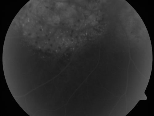 Pigmented Choroidal Mass Right Eye - Melanoma vs. Nevus vs. Unilateral Melanocytic Proliferation - 4 Month Follow-Up Images
71-year-old man his vision 4 month follow-up.  Vision is 20/60 and patient sees flashing lights.  Lesion has grown slightly in the superior half of the macula.
