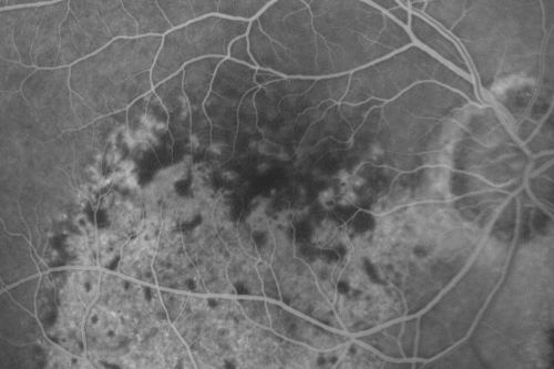 Pigmented Choroidal Mass Right Eye - Melanoma vs. Nevus vs. Unilateral Melanocytic Proliferation - Initial Visit
71-year-old man is vision has been bothering him for about a month.  He does not notice one eye particularly worse than the other.  OD is 20/40, OS is 20/25 - Initial Visit

