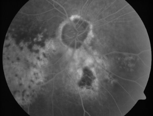 Pigmented Choroidal Mass Right Eye - Melanoma vs. Nevus vs. Unilateral Melanocytic Proliferation - Initial Visit
71-year-old man is vision has been bothering him for about a month.  He does not notice one eye particularly worse than the other.  OD is 20/40, OS is 20/25 - Initial Visit
