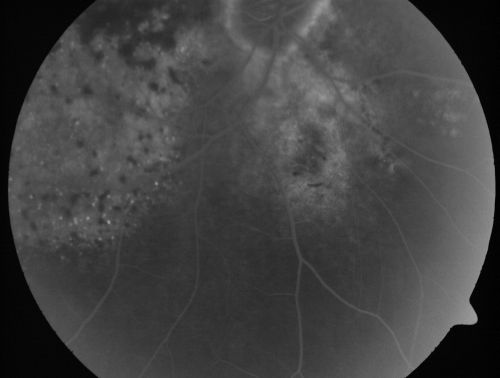 Pigmented Choroidal Mass Right Eye - Melanoma vs. Nevus vs. Unilateral Melanocytic Proliferation - Initial Visit
71-year-old man is vision has been bothering him for about a month.  He does not notice one eye particularly worse than the other.  OD is 20/40, OS is 20/25 - Initial Visit71-year-old man is vision has been bothering him for about a month.  He does not notice one eye particularly worse than the other.  OD is 20/40, OS is 20/25 - Initial Visit
