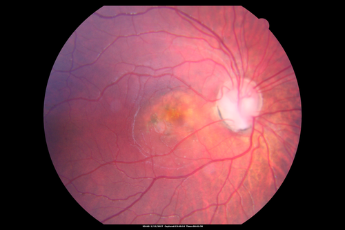 Optic Nerve Pit Retinal Detachment - SD OCT of Nerve EDI shows Pit
9 Year old with morning glory disc who developed nerve pit RD.  Raster scans of the optic nerve on EDI setting show the communication between the subretinal space and the fluid around the cerebrospinal fluid surrounding the optic nerve sheath.
