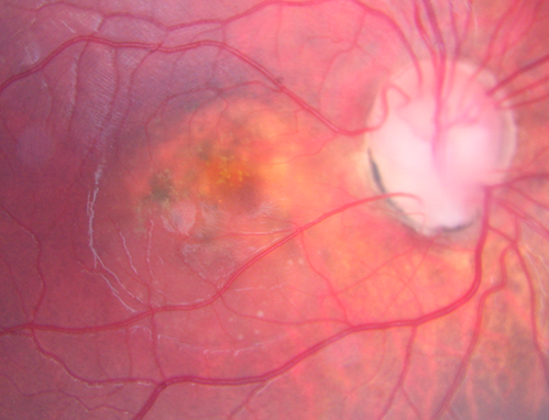 Optic Nerve Pit Maculopathy
10 year old child who had inner retinal fenestration (see youtube video on scohen125 channel) and did very well.
