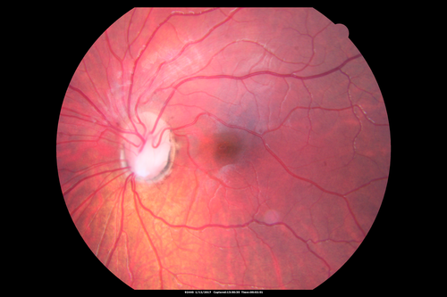 Optic Nerve Pit Retinal Detachment - SD OCT of Nerve EDI shows Pit
9 Year old with morning glory disc who developed nerve pit RD.  Raster scans of the optic nerve on EDI setting show the communication between the subretinal space and the fluid around the cerebrospinal fluid surrounding the optic nerve sheath.

