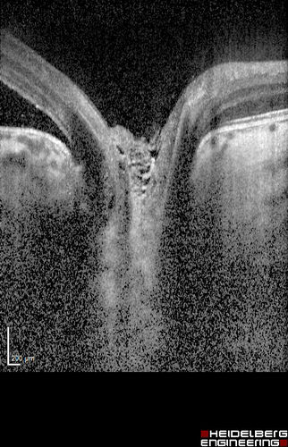 Optic Nerve Pit Retinal Detachment - SD OCT of Nerve EDI shows Pit
9 Year old with morning glory disc who developed nerve pit RD.  Raster scans of the optic nerve on EDI setting show the communication between the subretinal space and the fluid around the cerebrospinal fluid surrounding the optic nerve sheath.
