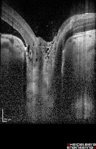 Optic Nerve Pit Retinal Detachment - SD OCT of Nerve EDI shows Pit
9 Year old with morning glory disc who developed nerve pit RD.  Raster scans of the optic nerve on EDI setting show the communication between the subretinal space and the fluid around the cerebrospinal fluid surrounding the optic nerve sheath.
