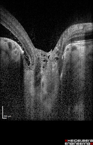 Optic Nerve Pit Retinal Detachment - SD OCT of Nerve EDI shows Pit
9 Year old with morning glory disc who developed nerve pit RD.  Raster scans of the optic nerve on EDI setting show the communication between the subretinal space and the fluid around the cerebrospinal fluid surrounding the optic nerve sheath.
