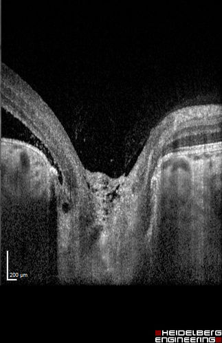 Optic Nerve Pit Maculopathy
10 year old child who had inner retinal fenestration (see youtube video on scohen125 channel) and did very well.
