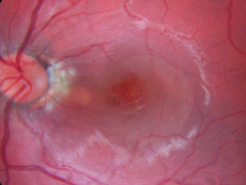 Optic Nerve Pit  Retinal Detachment - Macular Detachment - 8 Year Old - Fresh Laser
8-year-old child on two school exams that his vision was poor in the left eye and his last normal exam was in preschool. 

VISUAL ACUITY:  OD 20/30,  OS 5/200.   OS: Vertical C/D ratio is 0.2.  There is a whitening on the temporal edge of the optic nerve consistent with an optic disc pit and there is a serous macular detachment.  

No better after 3 months observation.
