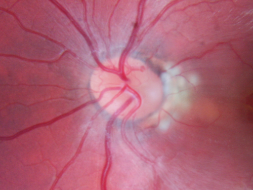 Optic Nerve Pit  Retinal Detachment - Macular Detachment - 8 Year Old - Fresh Laser
8-year-old child on two school exams that his vision was poor in the left eye and his last normal exam was in preschool. 

VISUAL ACUITY:  OD 20/30,  OS 5/200.   OS: Vertical C/D ratio is 0.2.  There is a whitening on the temporal edge of the optic nerve consistent with an optic disc pit and there is a serous macular detachment.  

No better after 3 months observation.
