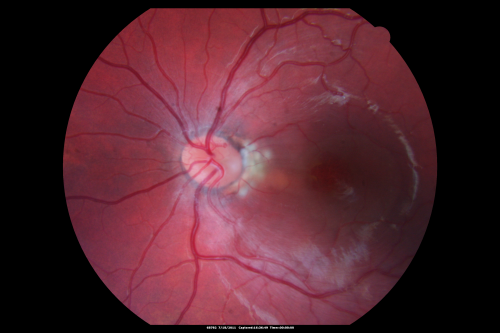 Optic Nerve Pit  Retinal Detachment - Macular Detachment - 8 Year Old - Fresh Laser
8-year-old child on two school exams that his vision was poor in the left eye and his last normal exam was in preschool. 

VISUAL ACUITY:  OD 20/30,  OS 5/200.   OS: Vertical C/D ratio is 0.2.  There is a whitening on the temporal edge of the optic nerve consistent with an optic disc pit and there is a serous macular detachment.  

No better after 3 months observation.
