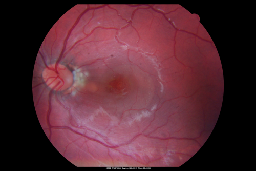 Optic Nerve Pit  Retinal Detachment - Macular Detachment - 8 Year Old - Fresh Laser
8-year-old child on two school exams that his vision was poor in the left eye and his last normal exam was in preschool. 

VISUAL ACUITY:  OD 20/30,  OS 5/200.   OS: Vertical C/D ratio is 0.2.  There is a whitening on the temporal edge of the optic nerve consistent with an optic disc pit and there is a serous macular detachment.  

No better after 3 months observation.
