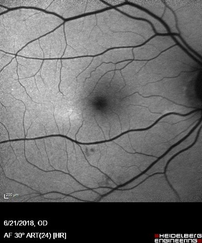 Hydroxychloroquine Toxicity - Mild
71 year old female with 200 mg BID plaquenil for 25 years.  Recent visual field showed abnomality.  FAF shows hyper FAF temporally and OCT shows mild outer retinal atrophy
