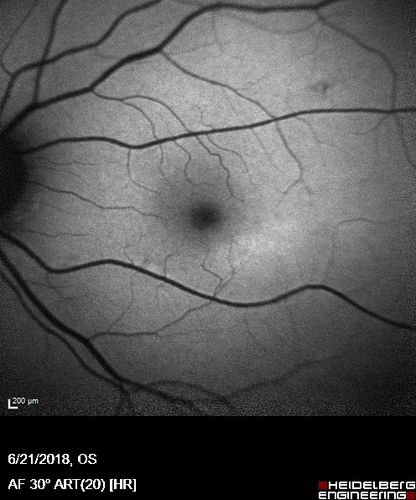 Hydroxychloroquine Toxicity - Mild
71 year old female with 200 mg BID plaquenil for 25 years.  Recent visual field showed abnomality.  FAF shows hyper FAF temporally and OCT shows mild outer retinal atrophy
